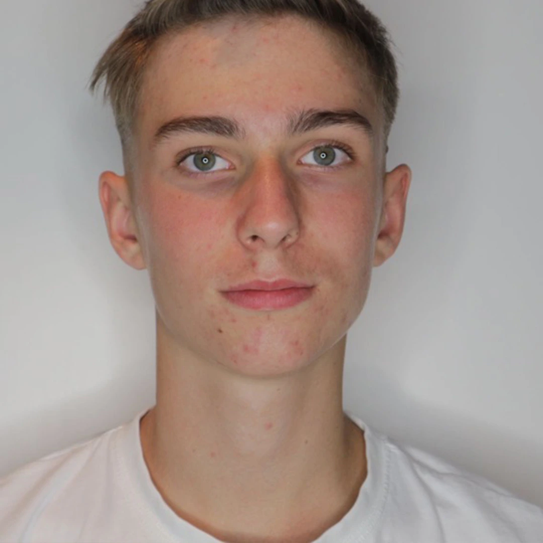 Matteo Resultate Skin Clear Young  irritierte Haut pickel After