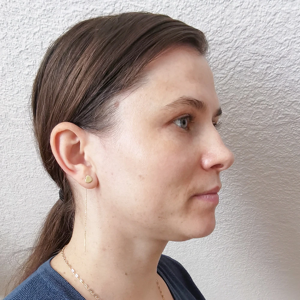 Cristina Behandlung Pigmentflecken Altersflecken after