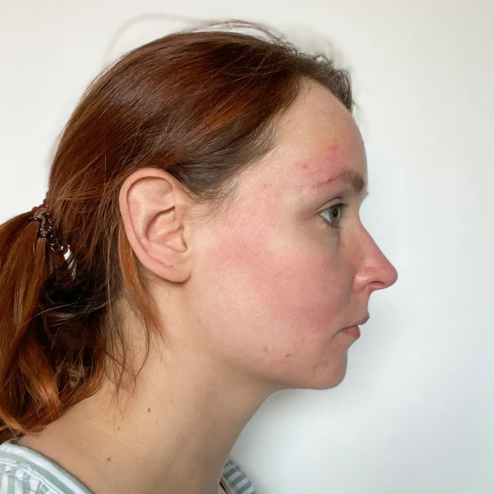 Friederike Resultate Skin Clear Dry Haut Unreinheiten Flecken Pickel After