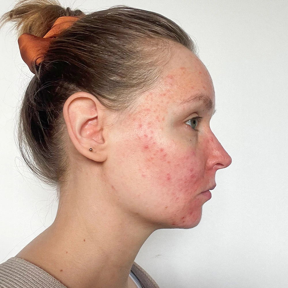 Friederike Resultate Skin Clear Dry Haut Unreinheiten Flecken Pickel Before