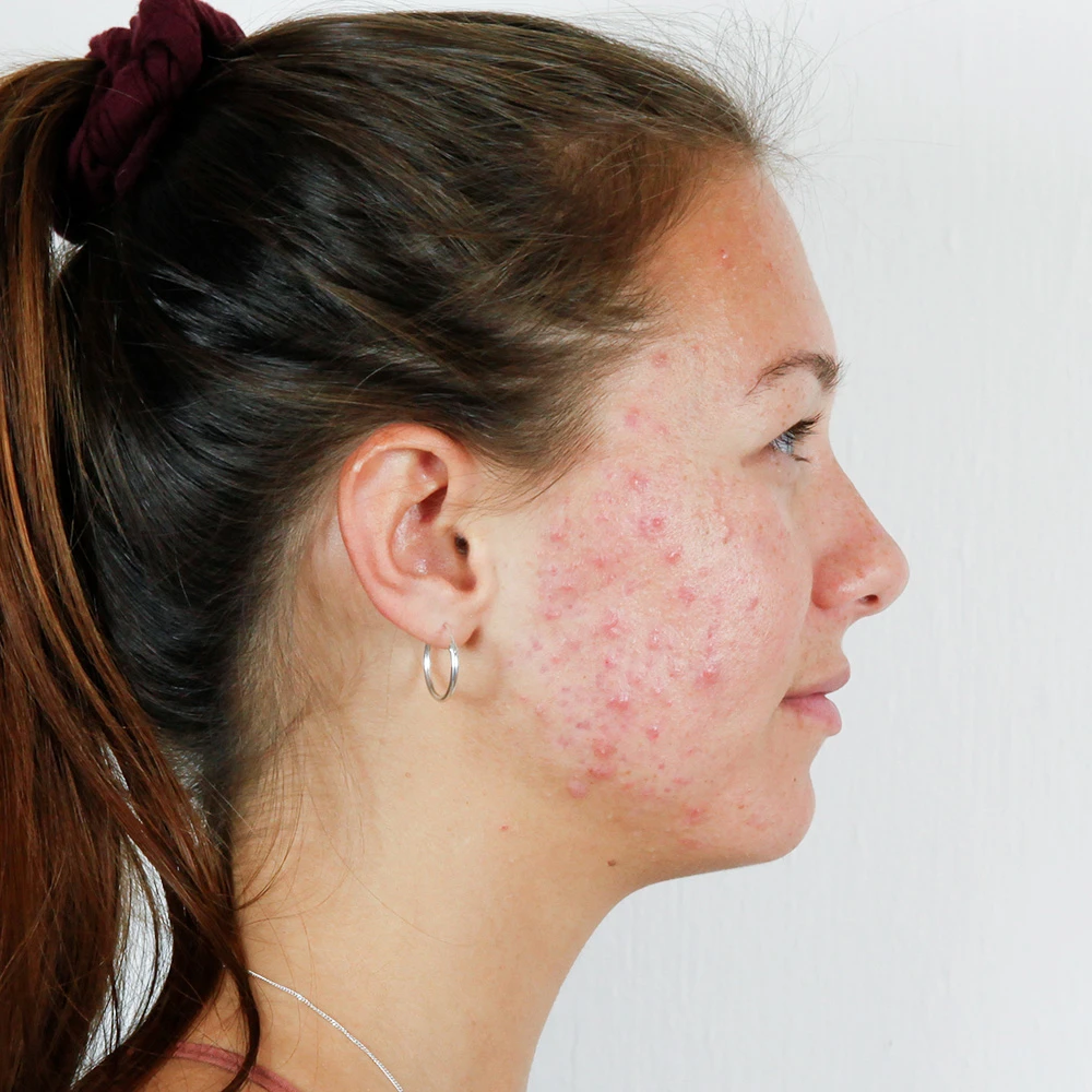 Gina Resultate Skin Clear Adult ölige Haut Pickel Before