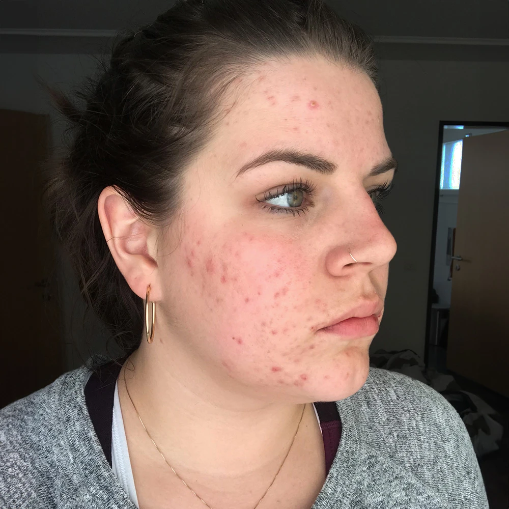 Jacqueline Resultate Skin Clear Dry Haut Unreinheiten Flecken Pickel before