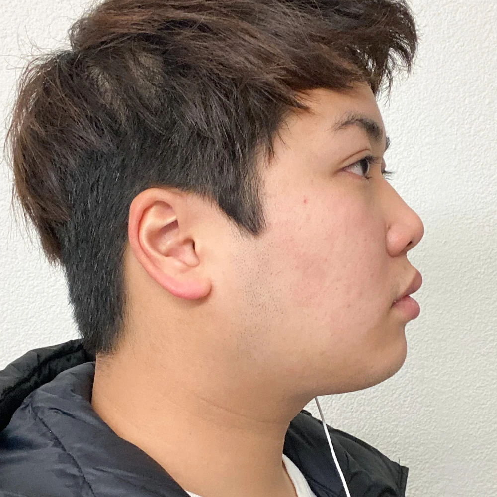 Kyle Resultate Skin Clear Adult fettiger Haut Pickeln After