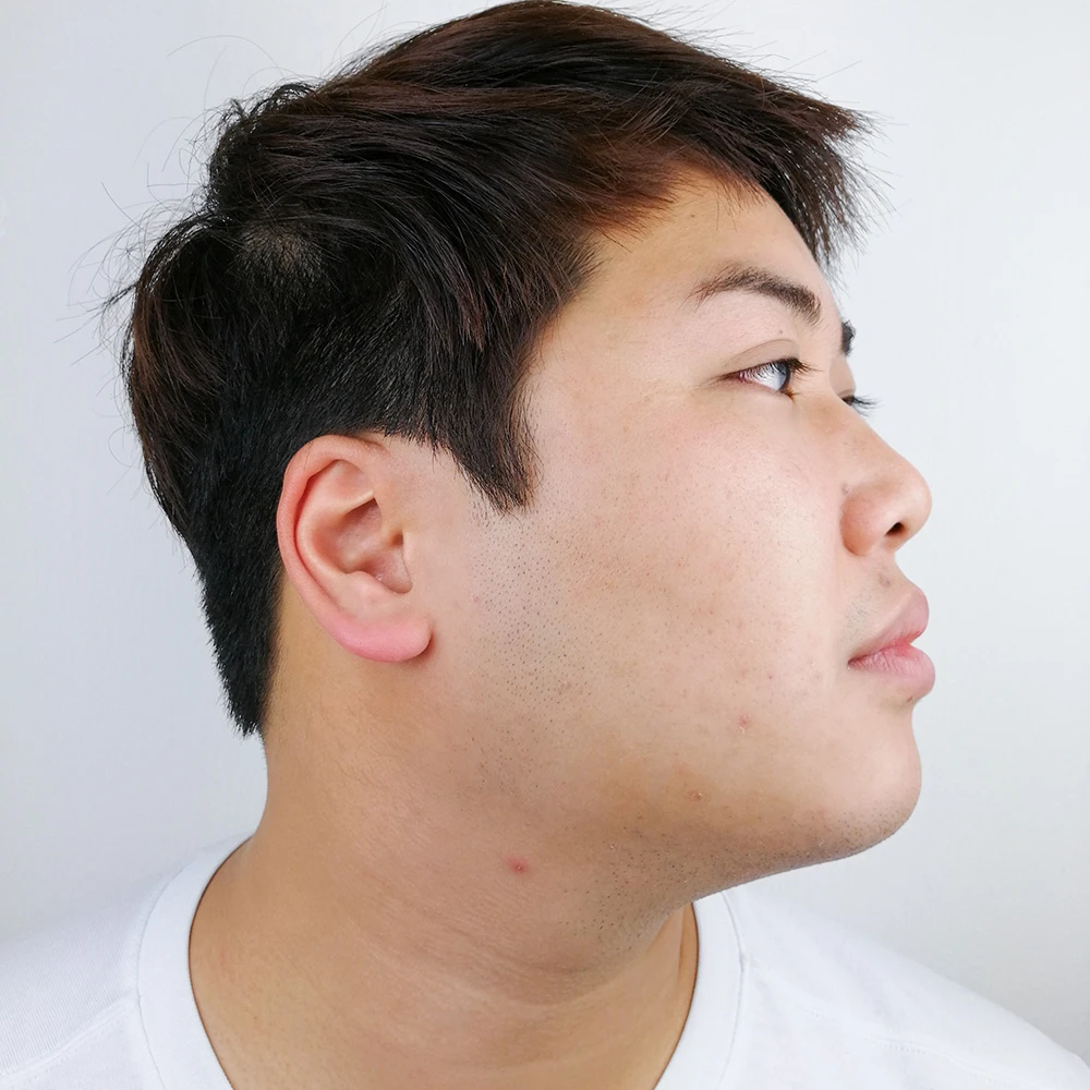 Kyle Resultate Skin Clear Adult fettiger Haut Pickeln Before