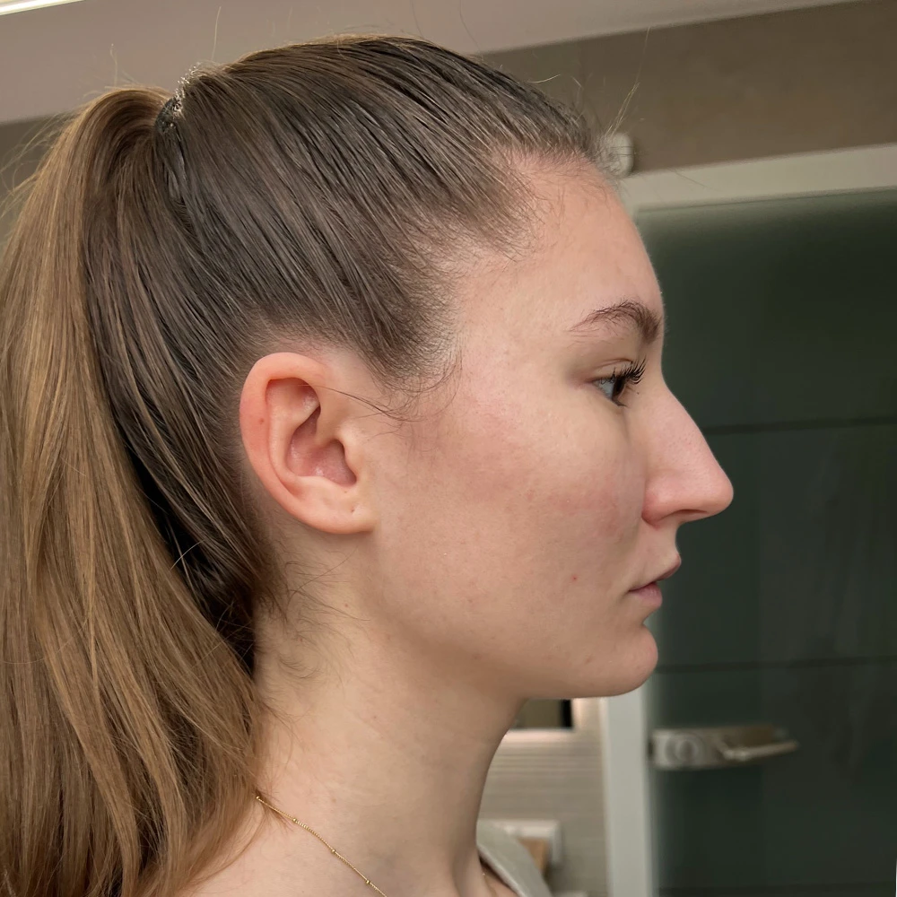 Lara Resultate Balanced Skin Ekzem irritierte Haut pickel after