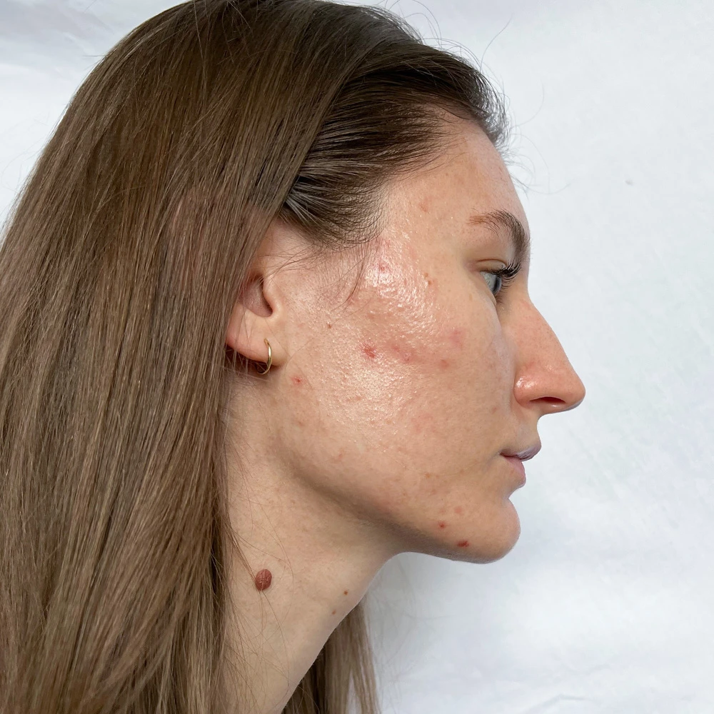 Lara Resultate Balanced Skin Ekzem irritierte Haut pickel before