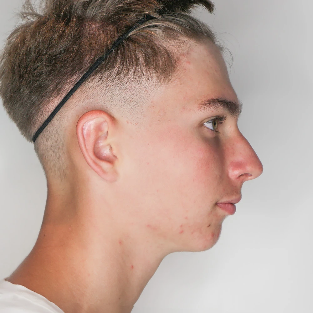 Matteo Resultate Skin Clear Young  irritierte Haut pickel After