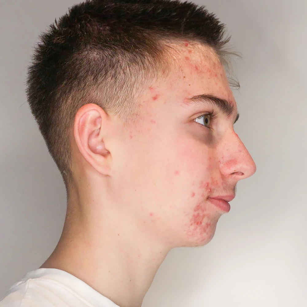 Matteo Resultate Skin Clear Young  irritierte Haut pickel Before