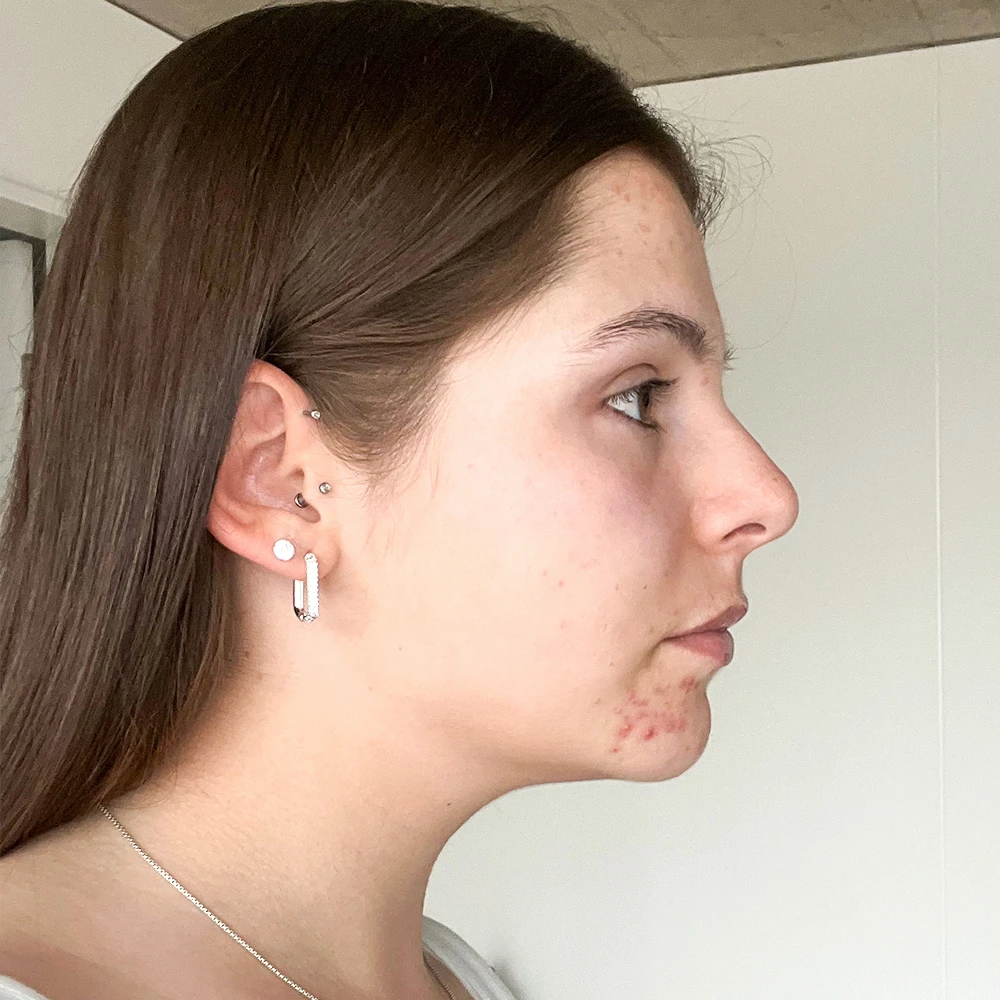 Michelle Resultate Mixed Skin T-Zone fettiger Haut Pickeln Flecken Before