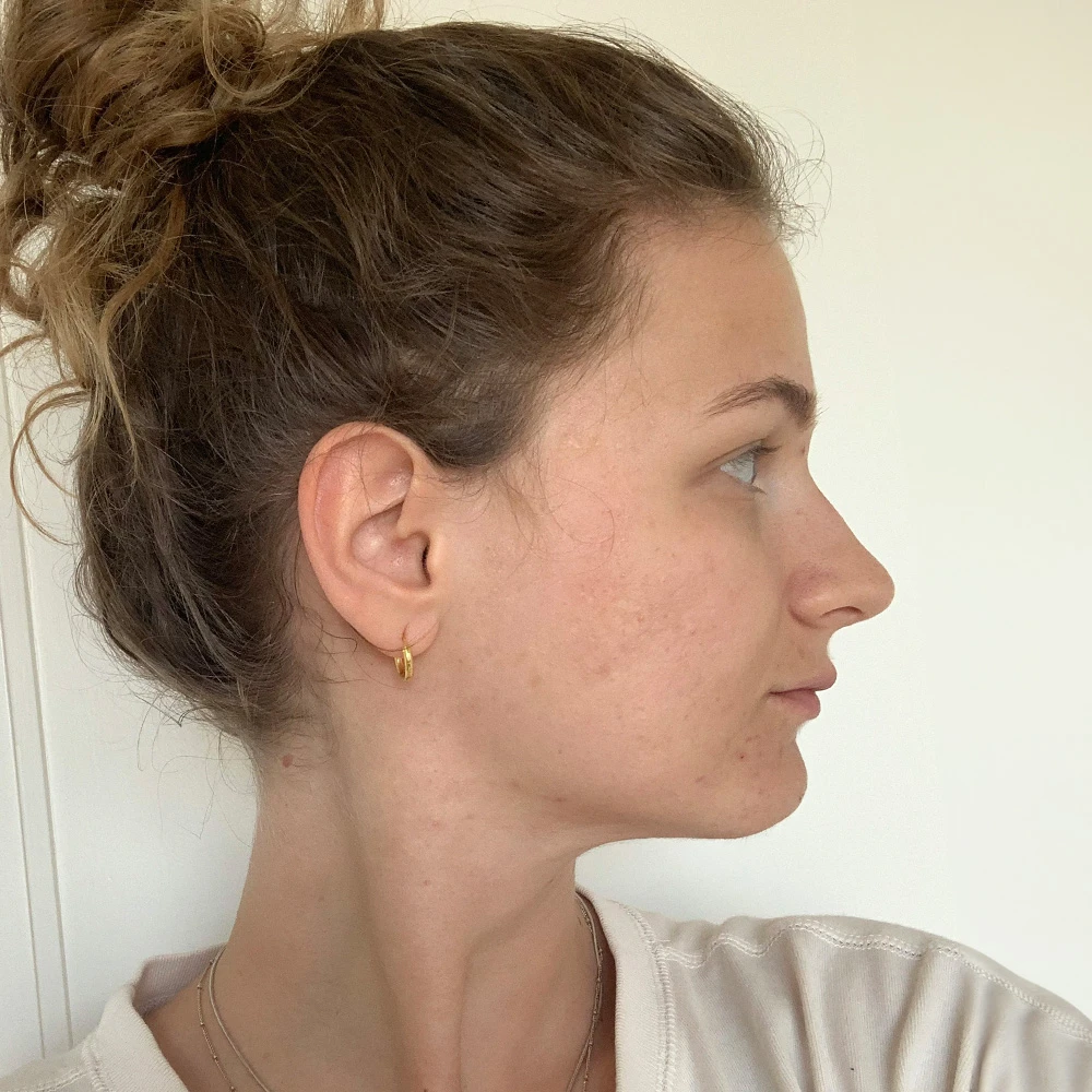 Momo Resultate Balanced Skin Ekzem irritierte Haut pickel Resultate before