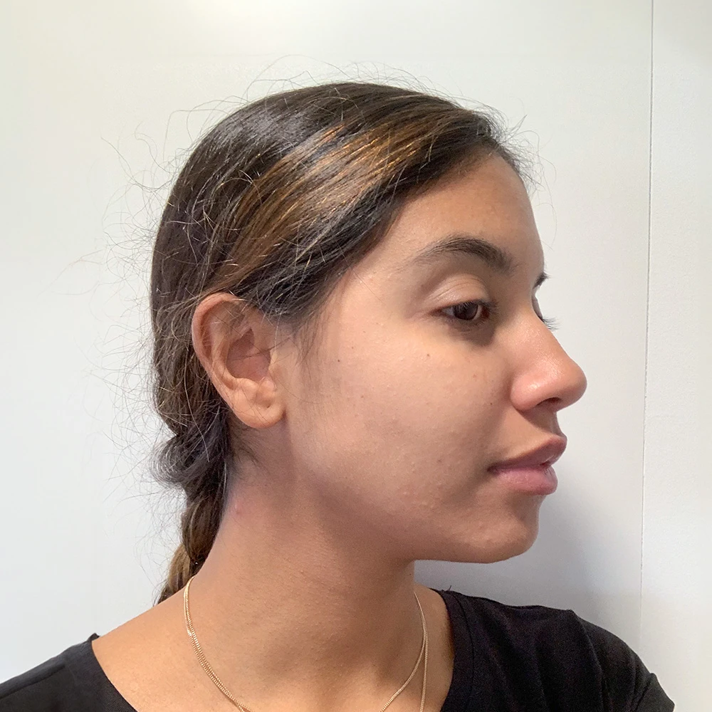 Monica Resultate Balanced Skin Ekzem irritierte Haut pickel Resultate after