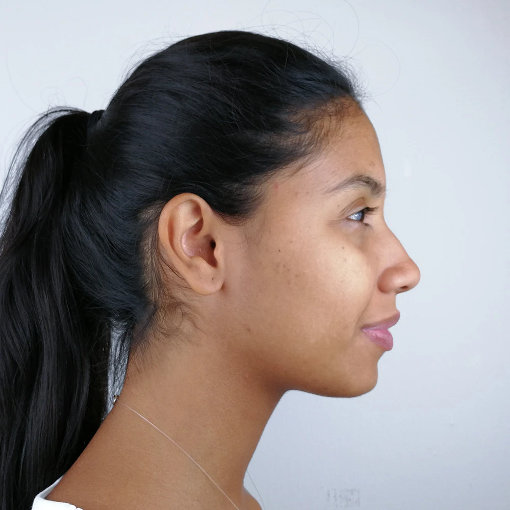 Monica Resultate Balanced Skin Ekzem irritierte Haut pickel Resultate before