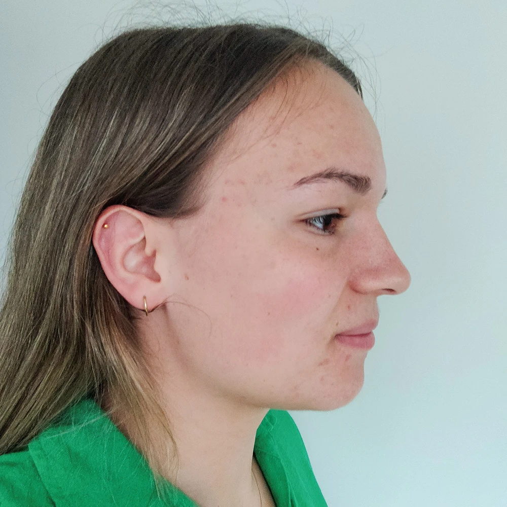 Petra Resultate Mixed Skin T-Zone fettiger Haut Pickeln Flecken after