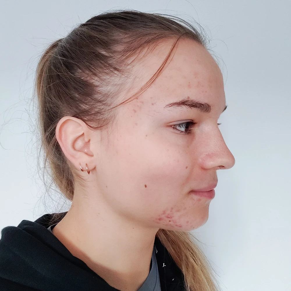 Petra Resultate Mixed Skin T-Zone fettiger Haut Pickeln Flecken Before