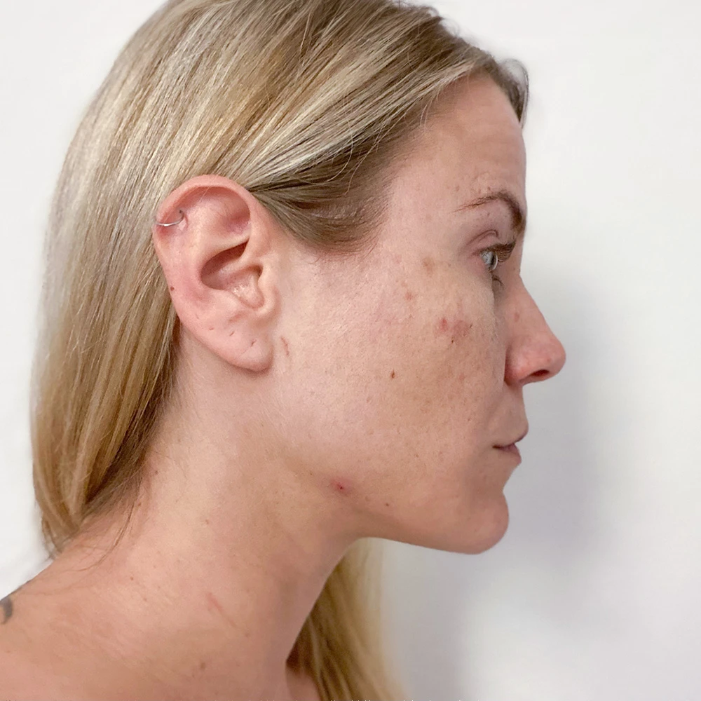 Sabrina Resultate Mixed Skin T-Zone fettiger Haut Pickeln Flecken Before