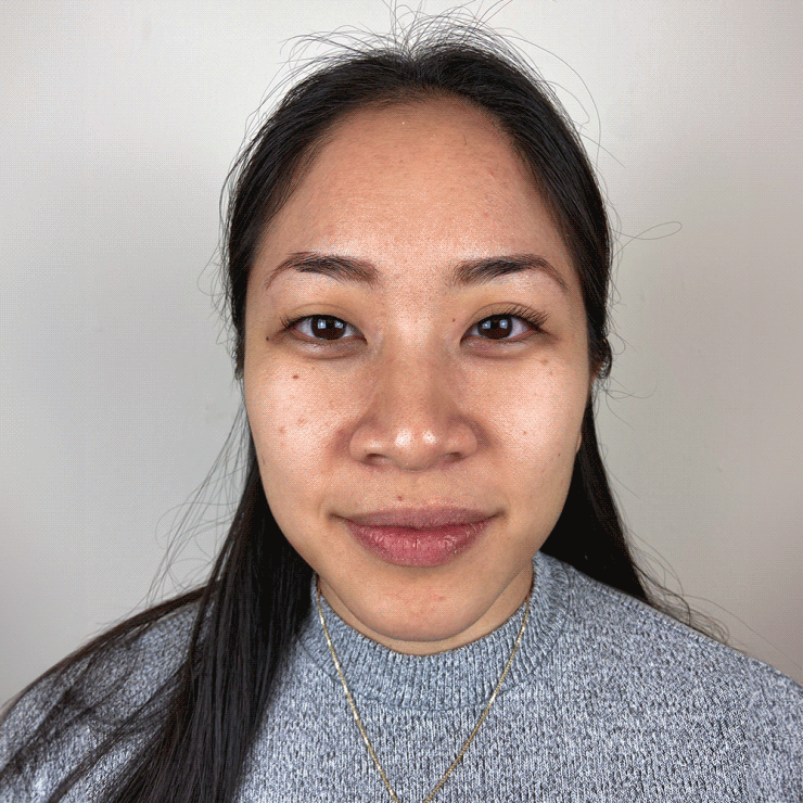 Pigmentstörungen Behandlung Pigmentflecken Altersflecken Resultate vorher nachher