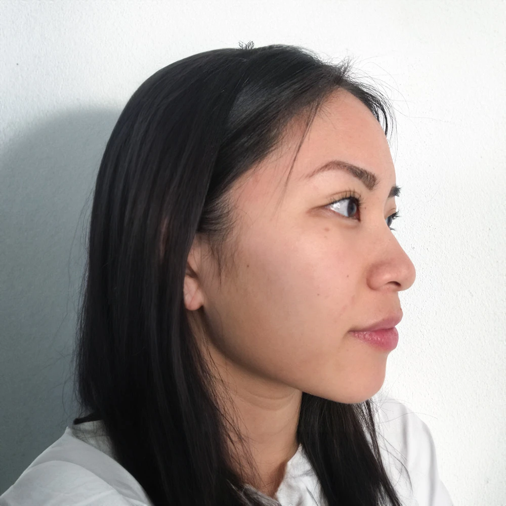 Pigmentstörungen Behandlung Pigmentflecken Altersflecken Resultate vorher nachher after