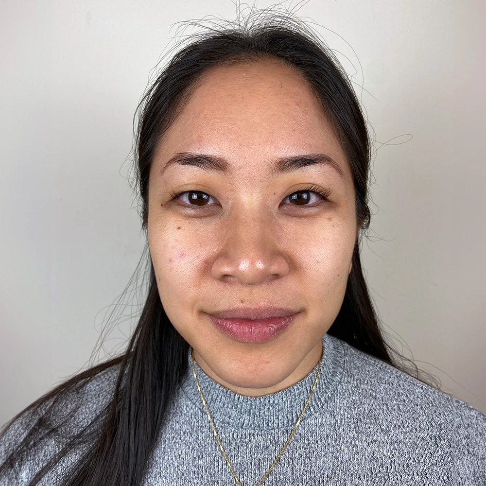 Pigmentstörungen Behandlung Pigmentflecken Altersflecken Resultate vorher nachher before