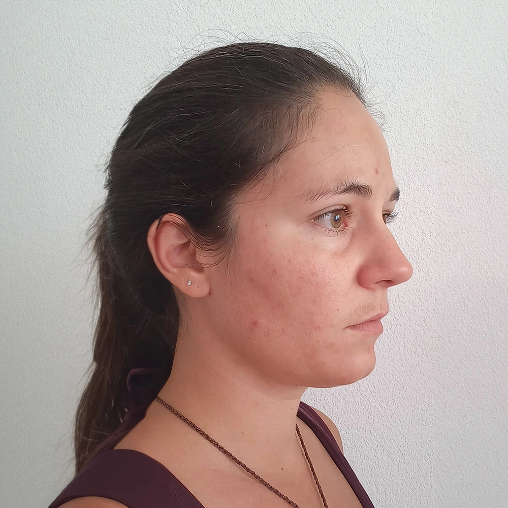 Sophie Pigmentstörungen Behandlung Pigmentflecken Altersflecken Resultate vorher nachher after