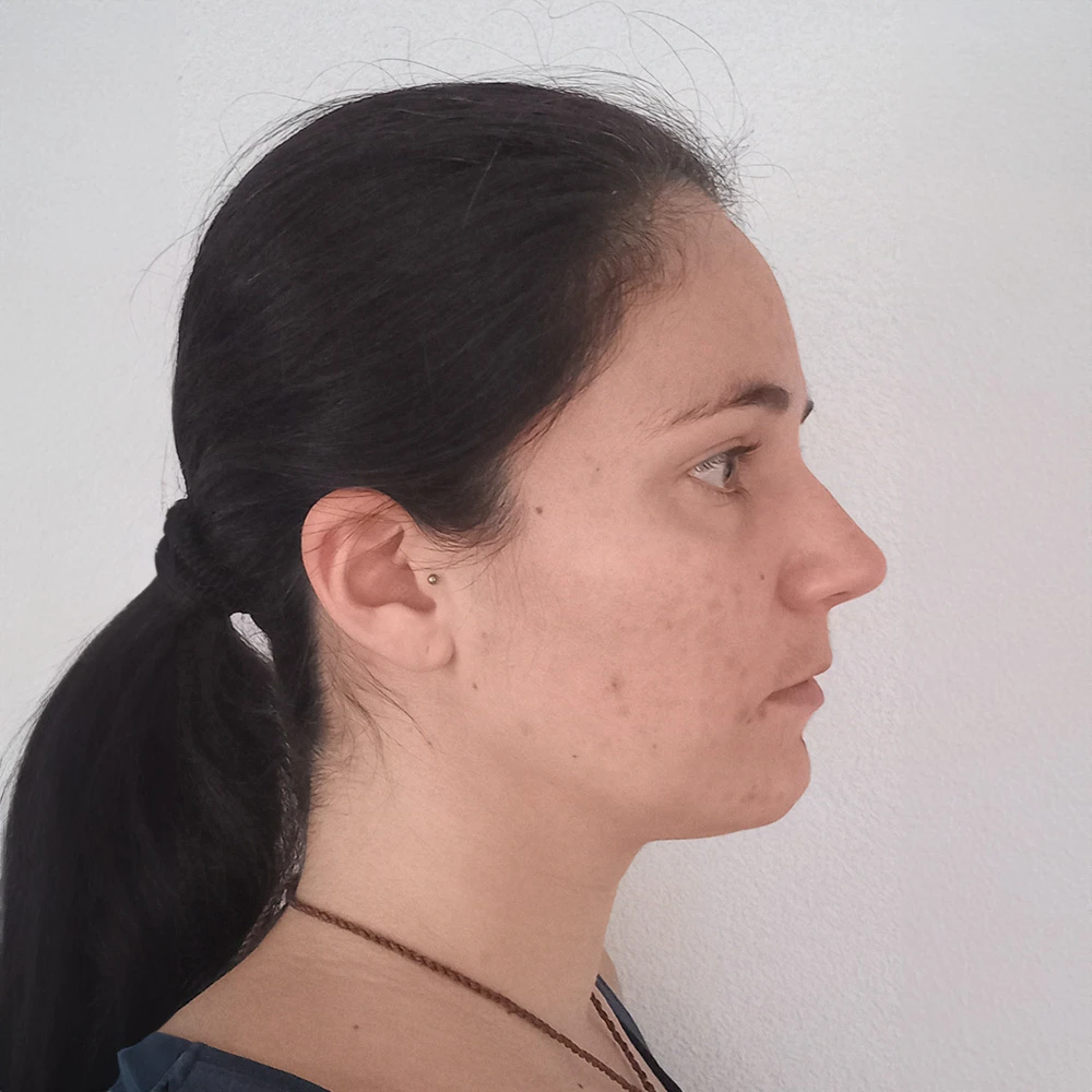 Sophie Pigmentstörungen Behandlung Pigmentflecken Altersflecken Resultate vorher nachher before