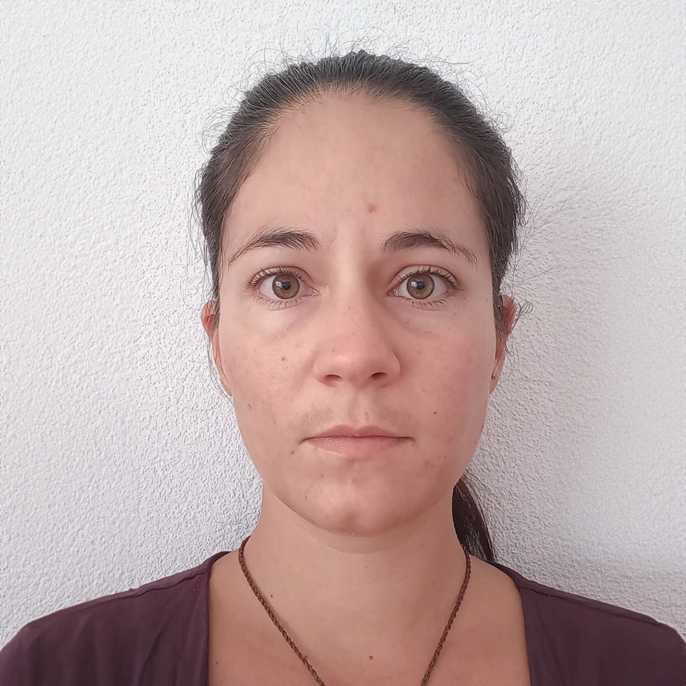 Sophie Pigmentstörungen Behandlung Pigmentflecken Altersflecken Resultate vorher nachher after