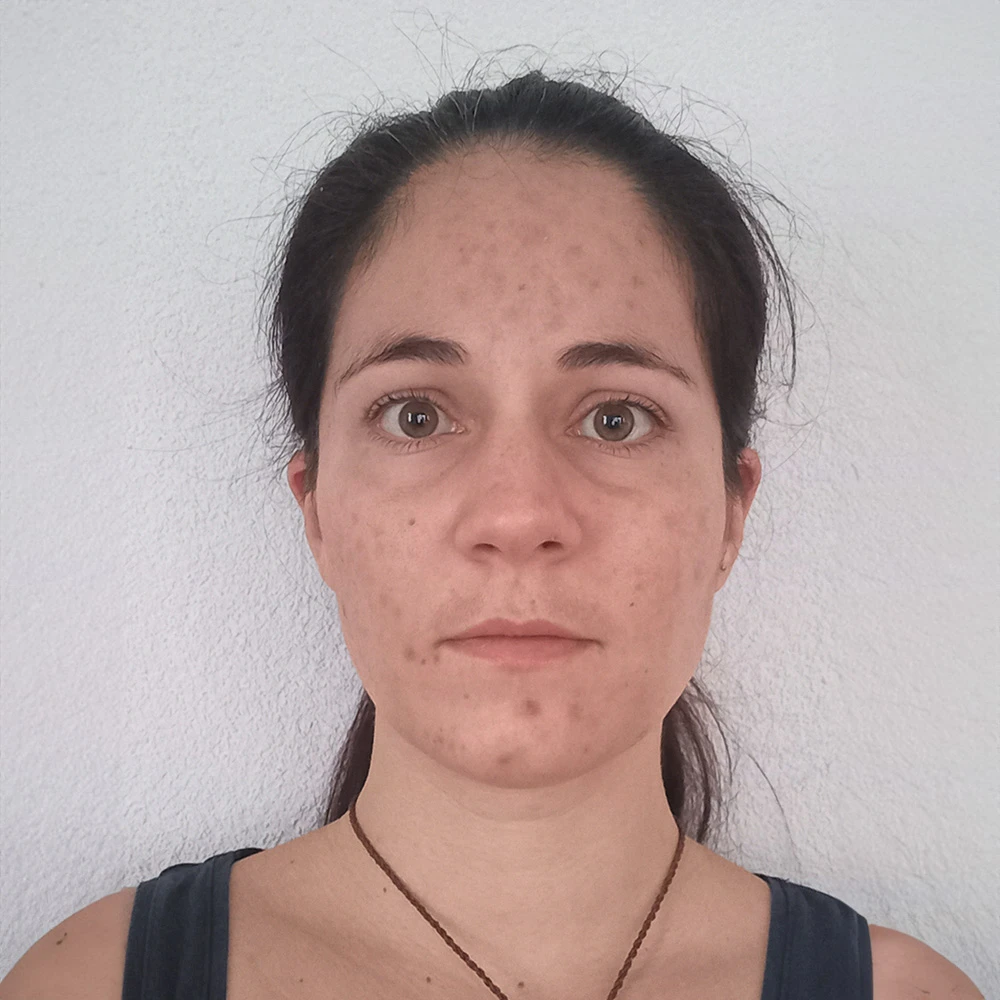 Sophie Pigmentstörungen Behandlung Pigmentflecken Altersflecken Resultate vorher nachher before