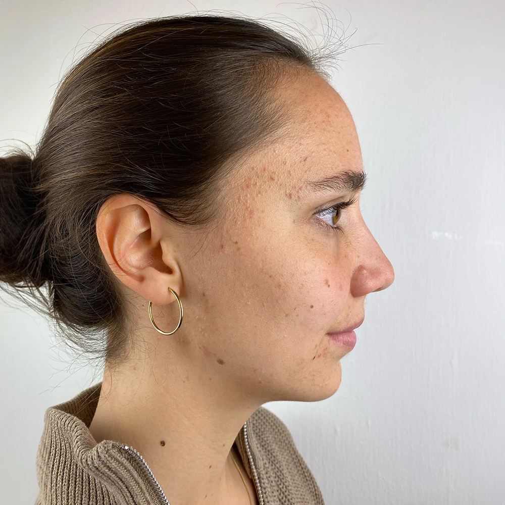 Aline Resultate Skin Clear Adult ölige Haut Pickel Before