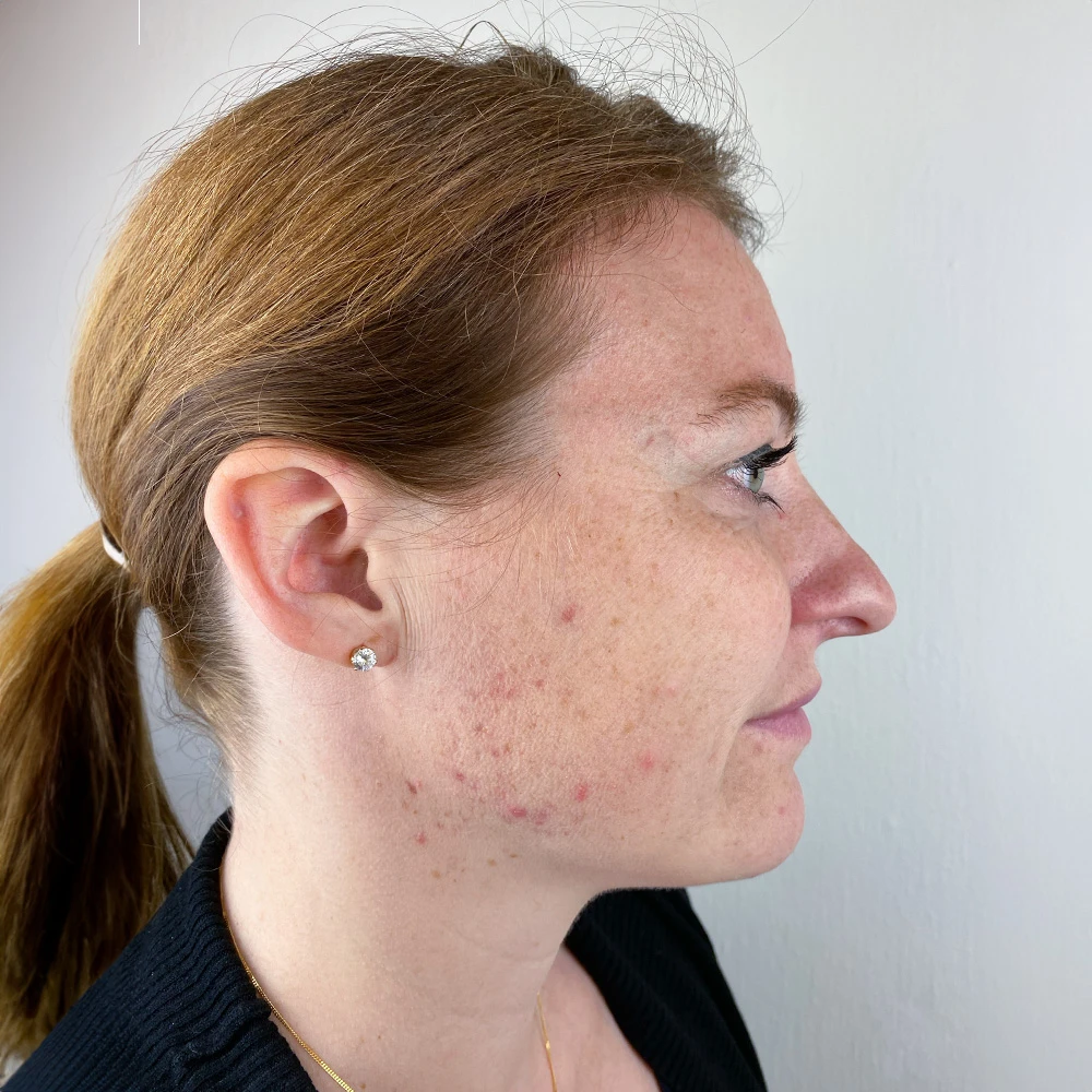 Andrea Pigmentstörungen Behandlung Pigmentflecken Altersflecken before