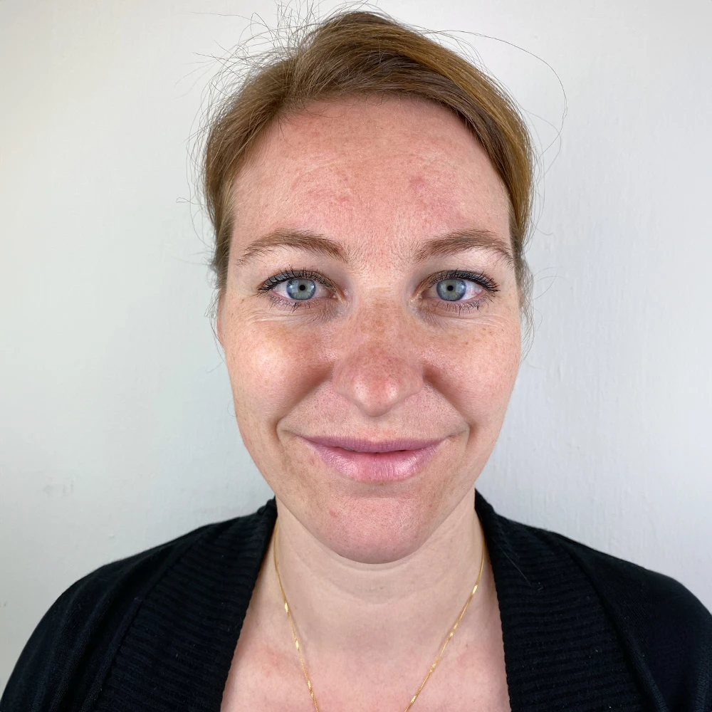 Andrea Pigmentstörungen Behandlung Pigmentflecken Altersflecken before