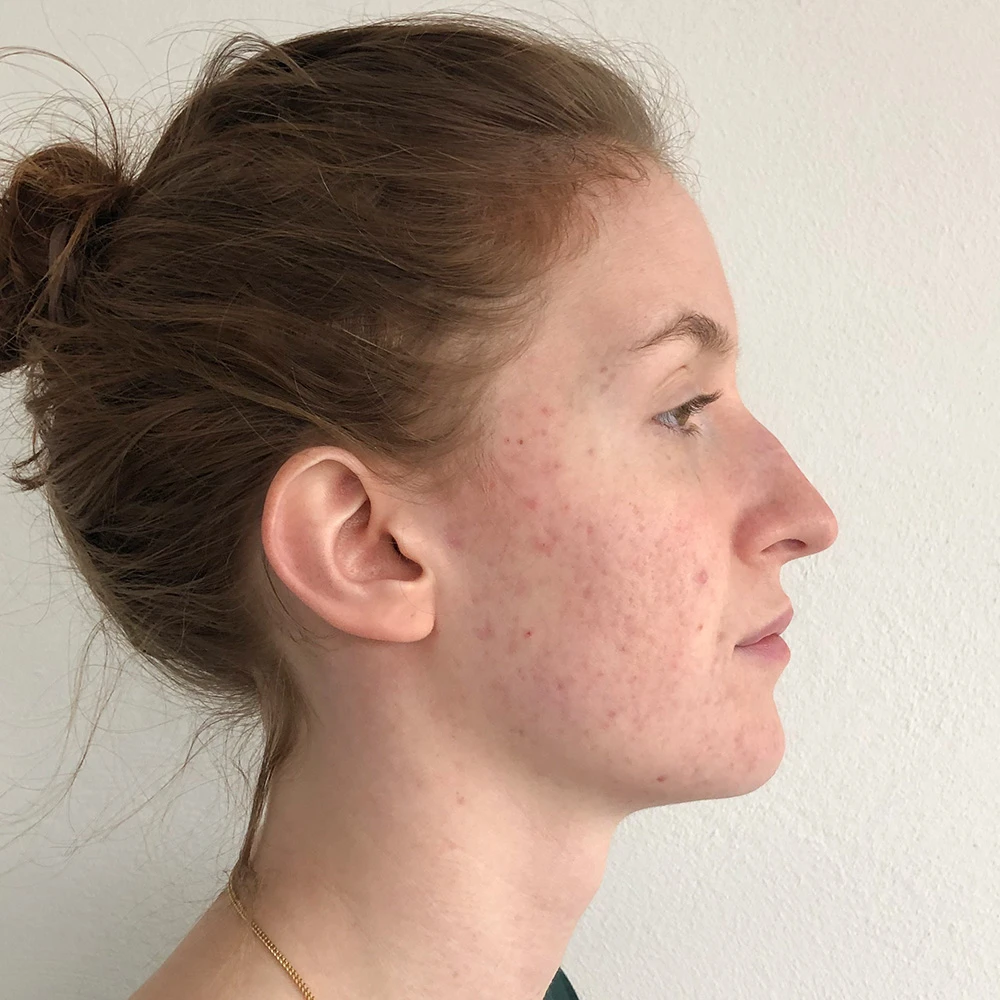 Belinda Resultate Irritated Skin trockener Haut Pickeln Mitessern Flecken After