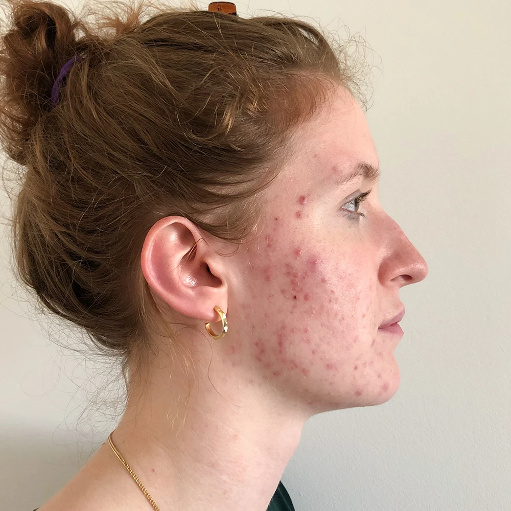 Belinda Resultate Irritated Skin trockener Haut Pickeln Mitessern Flecken Before