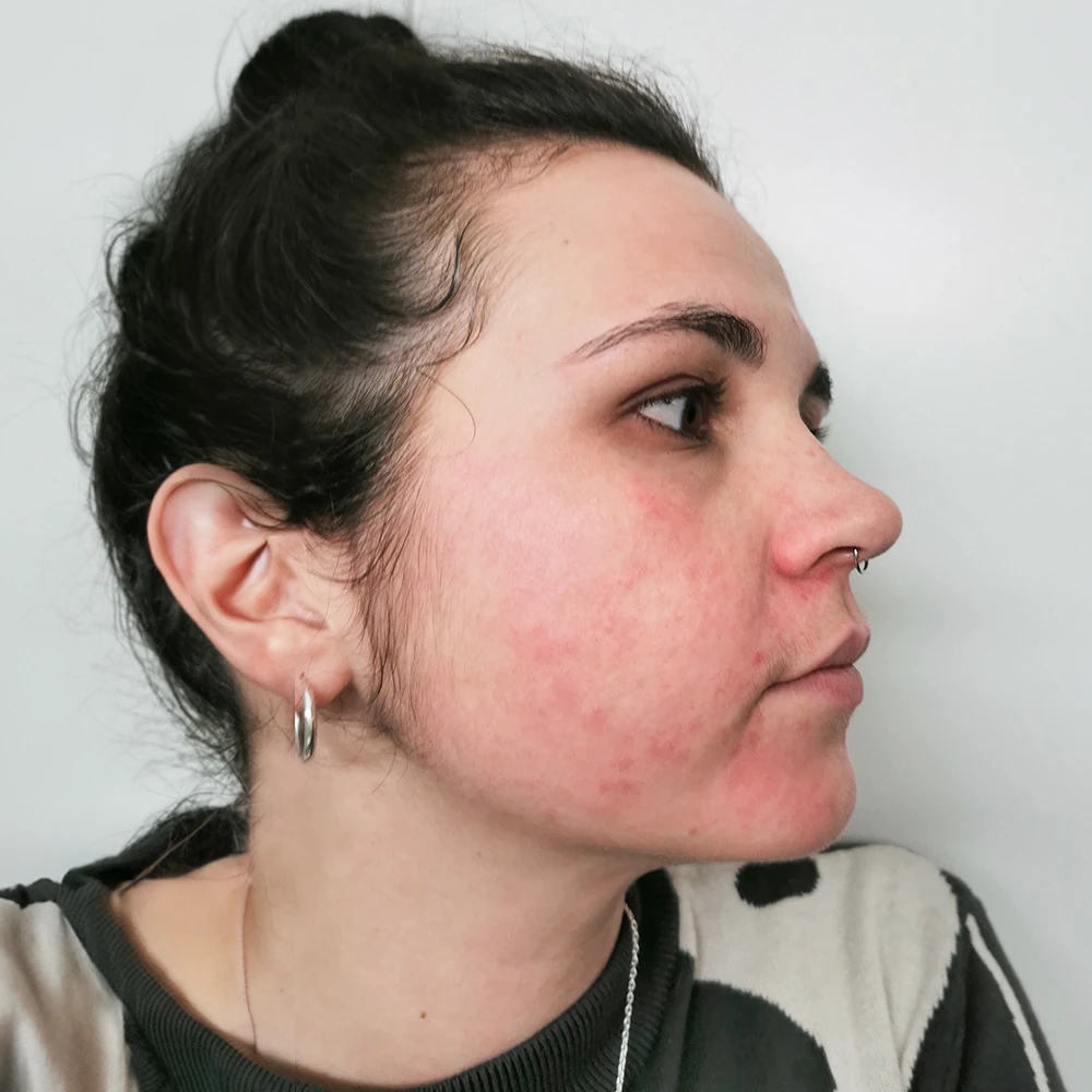 Gloria Resultate Balanced Skin Ekzem irritierte Haut pickel Before