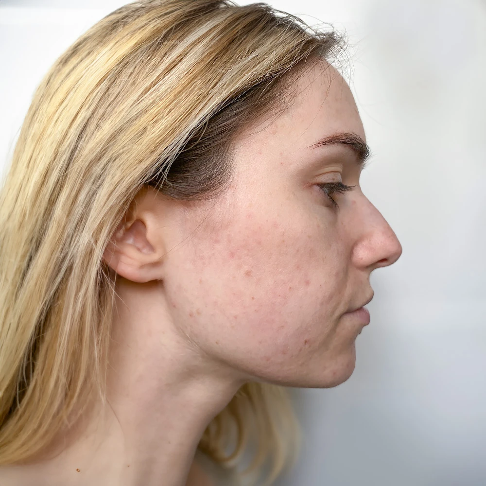 Larissa Resultate Skin Clear Dry Haut Unreinheiten Flecken Pickel After