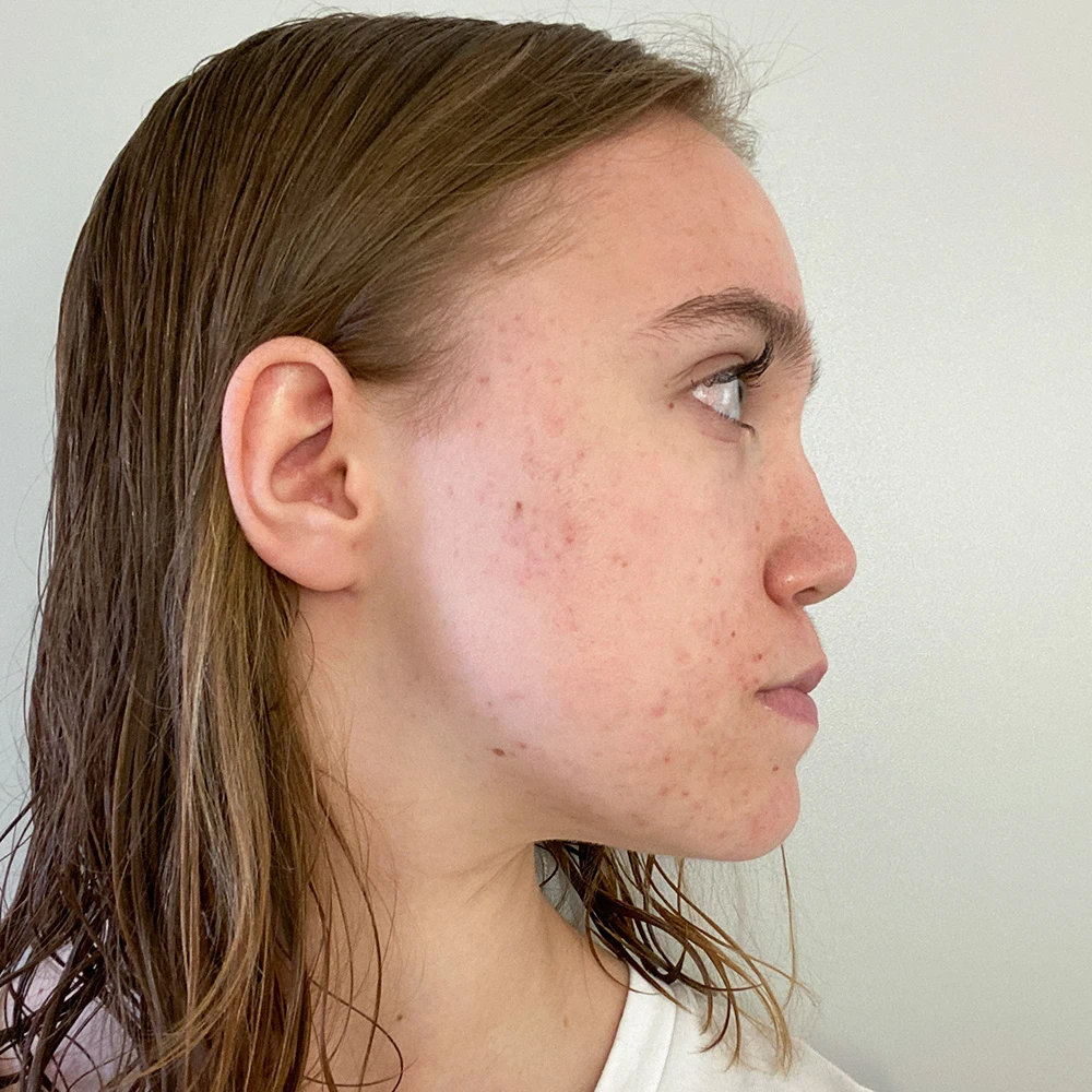 Malin Resultate Skin Clear Young irritierte Haut pickel After