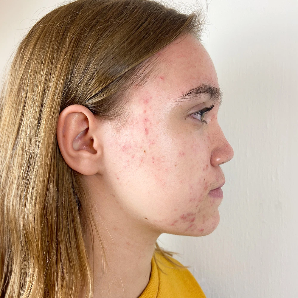 Malin Resultate Skin Clear Young irritierte Haut pickel Before