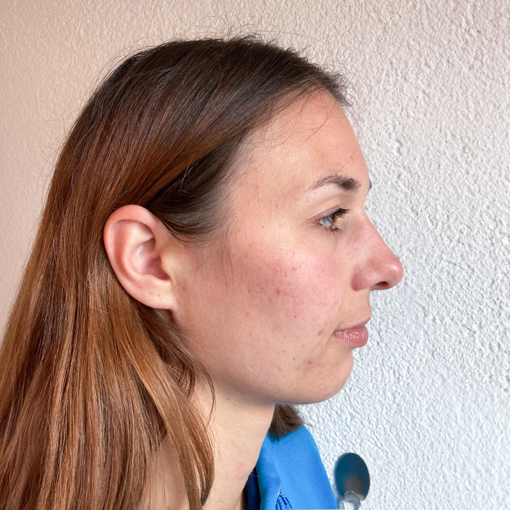 Michelle Resultate Skin Clear Adult ölige Haut Pickel after