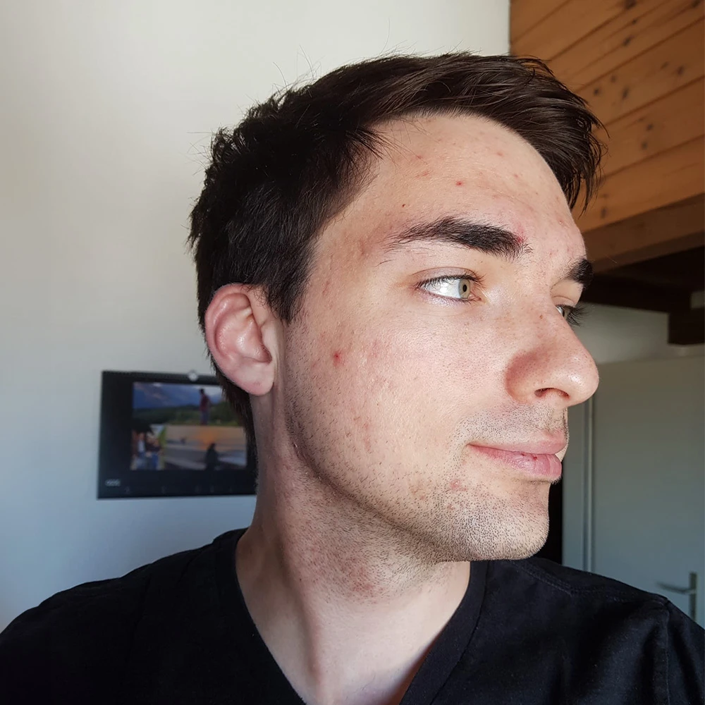 Pascal Resultate Skin Clear Dry Haut Unreinheiten Flecken Pickel After