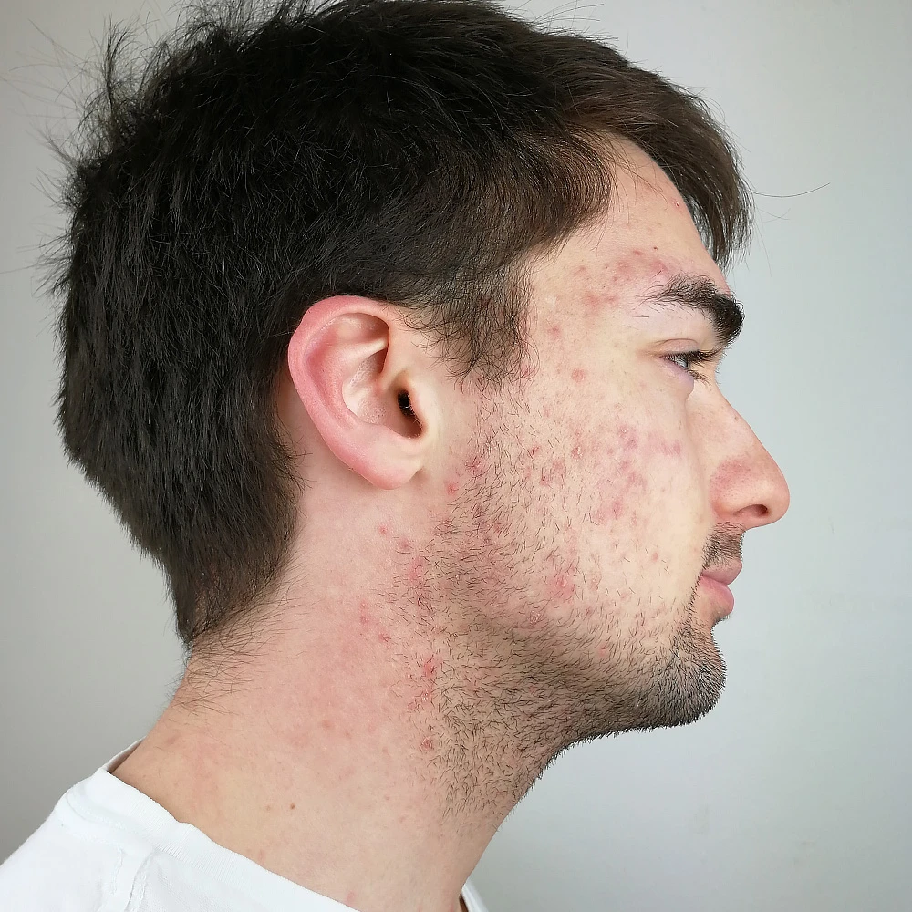 Pascal Resultate Skin Clear Dry Haut Unreinheiten Flecken Pickel Before